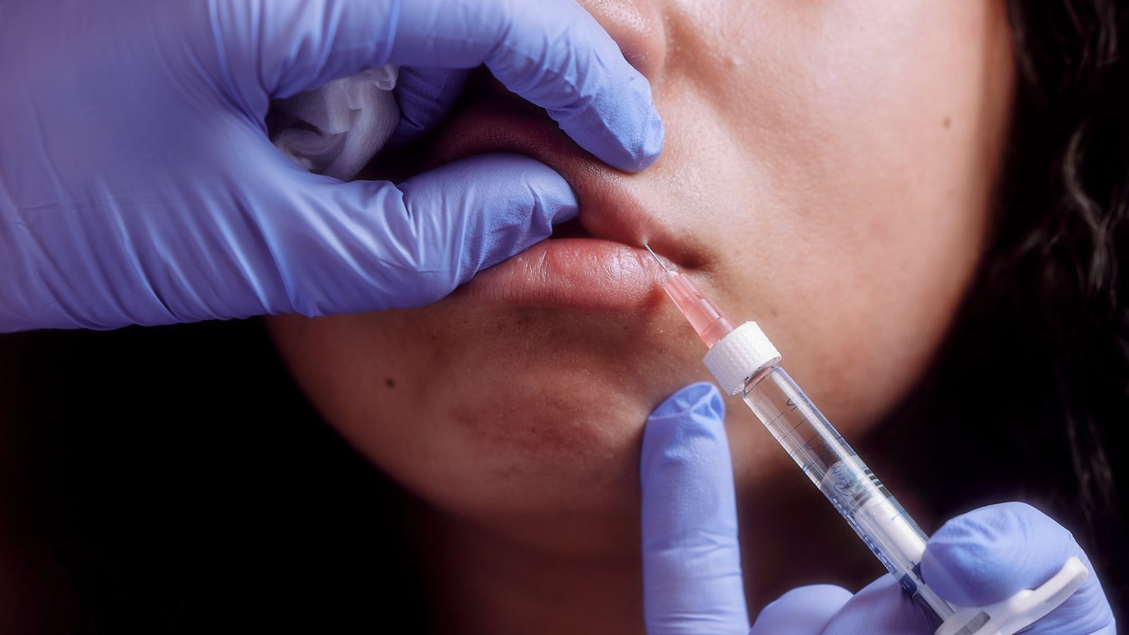 Gambar seorang pasien yang sedang disuntikkan lip fillers